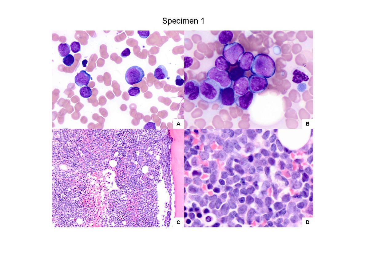 Figure 1. Review of microscopic findings from specimen 1. (A) Peripheral blood smear with numerous blasts, large in size with scant to moderate cytoplasm and some with fine azurophilic granules. No Auer rods were identified. Some of the blasts had slightly folded nuclear contours (500x). (B) Bone marrow smears showed markedly increased blasts with similar morphologic findings to that described in the peripheral blood smear (1000x). (C) and (D) Bone marrow biopsy showed 95% cellularity with sheets of large blasts with scant cytoplasm (C 200x; D 1000x).